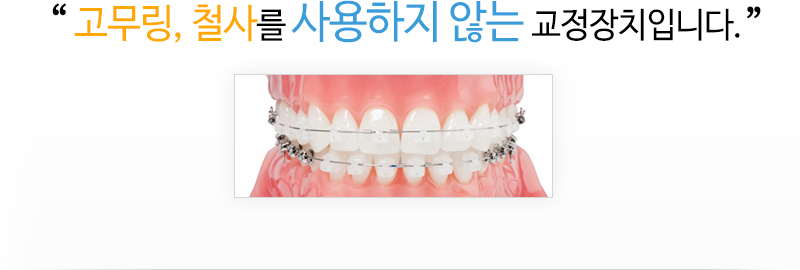 고무링, 철사를 사용하지 않는 교정장치입니다.